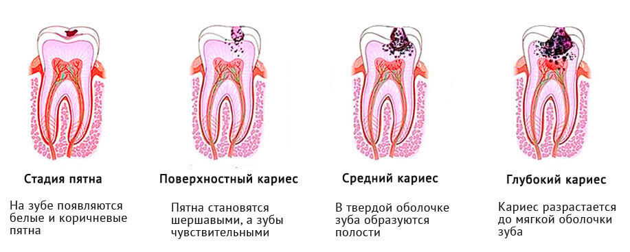 Лечение кариеса