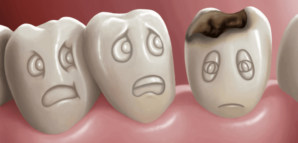 Кариес: что это